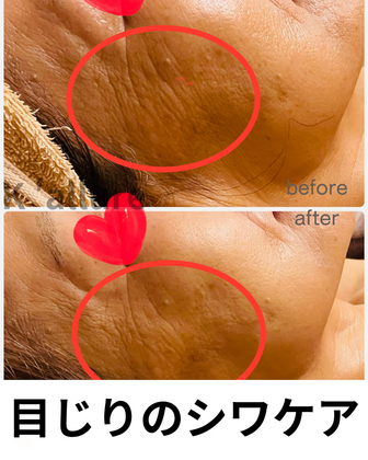70代目じりのシワ改善