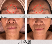 効果には個人差があります。
